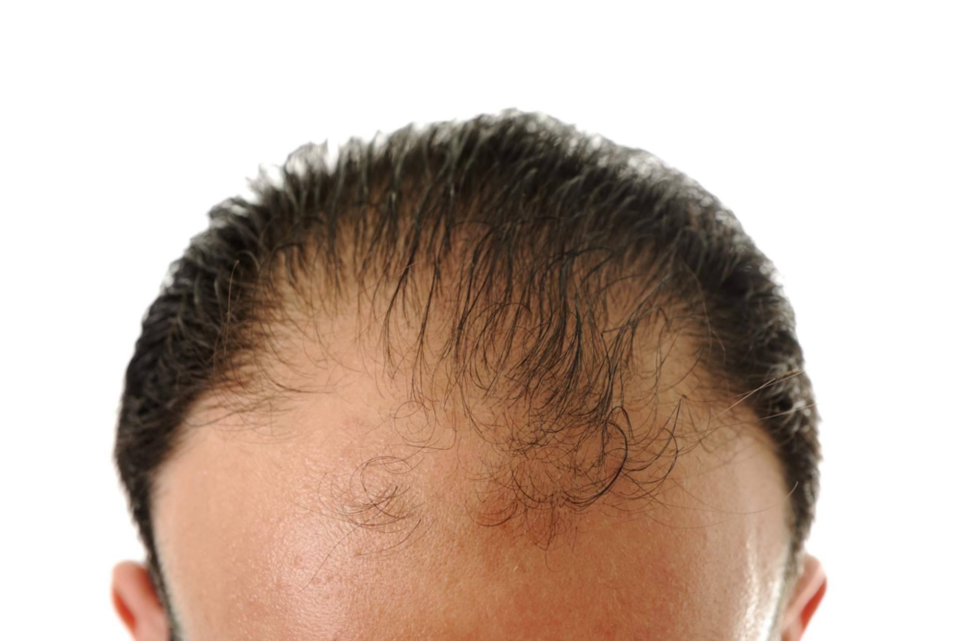 HairFluencer consolida su propuesta con productos destacados para el cuidado post trasplante capilar